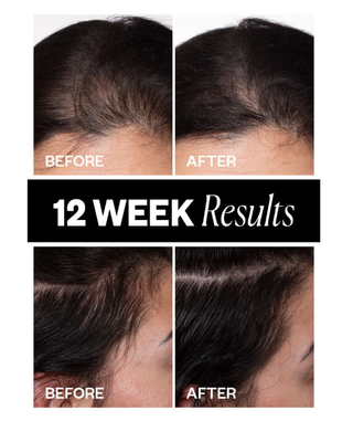 IGK Sponsored Hair Density Scalp Treatment